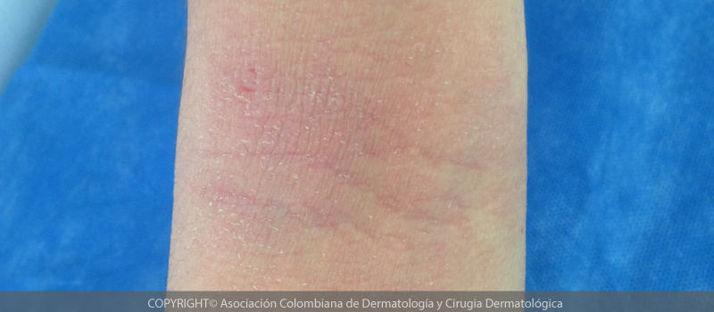 dermatitis-atopica4