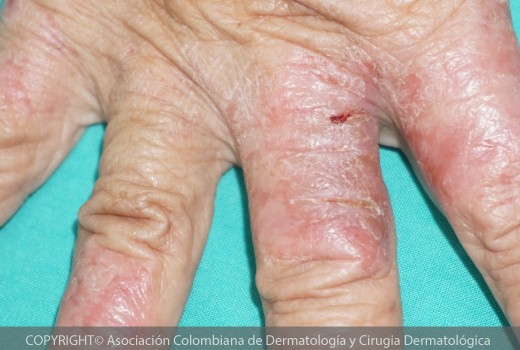 dermatitis-atopica5