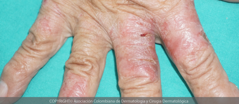 dermatitis-atopica5